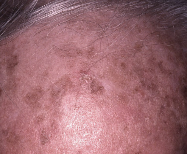 Queratose Actínica, múltiplas lesões