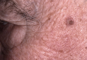 Lesão hiperqueratótica *