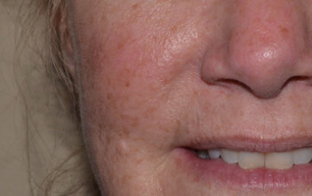 As lesões queratose Actínica