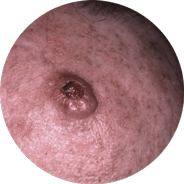 Carcinoma espinocelular invasivo